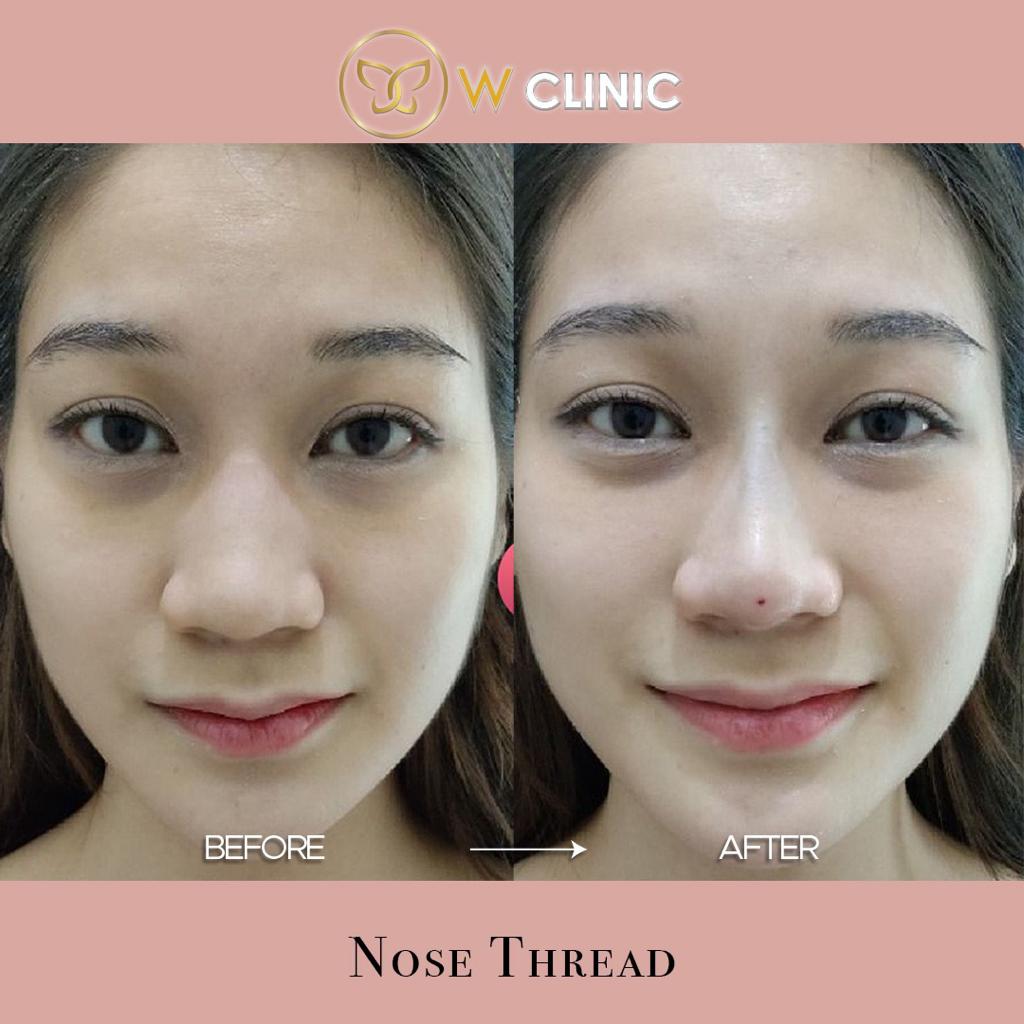 W CLINIC Nose Thread Lifting